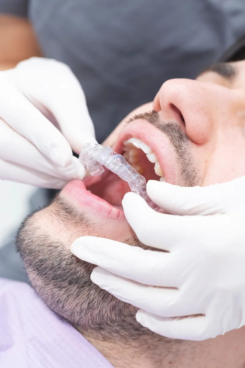 Dentist fitting a clear aligner for an adult patient