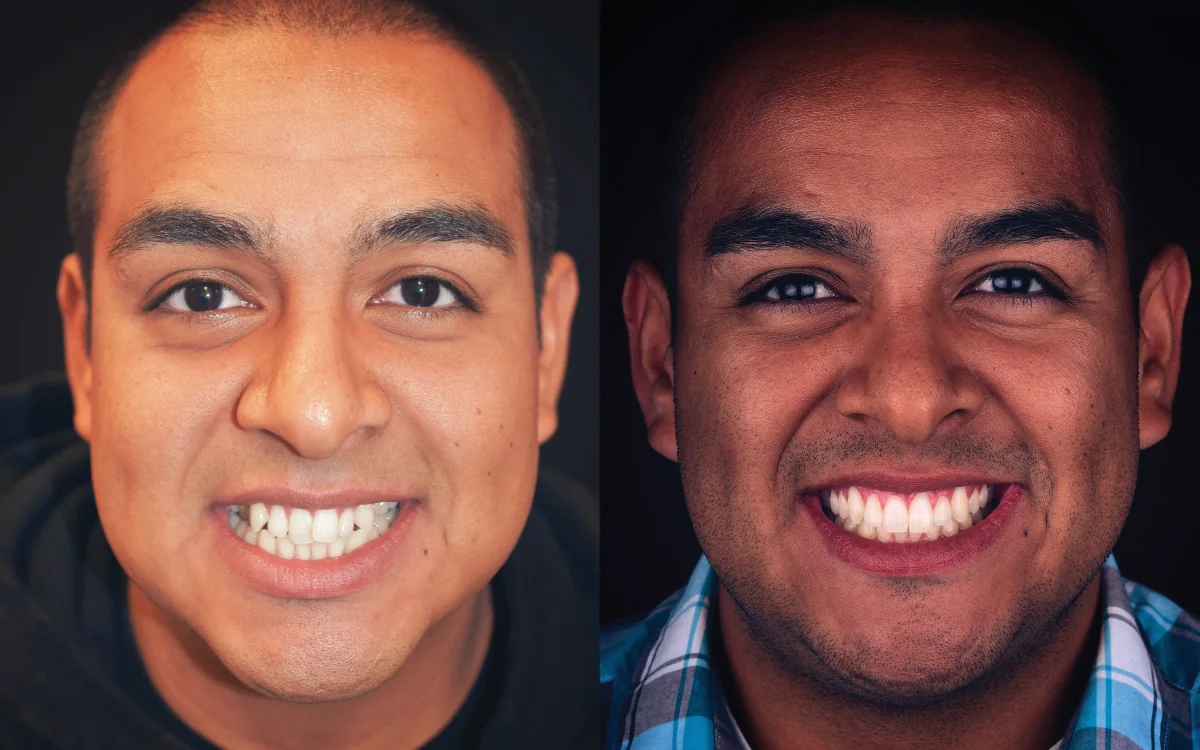 Adult orthodontic treatment before-and-after patient smile comparison