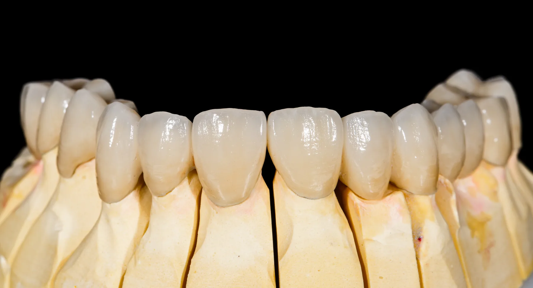 Ceramic fixed dental bridge restoration
