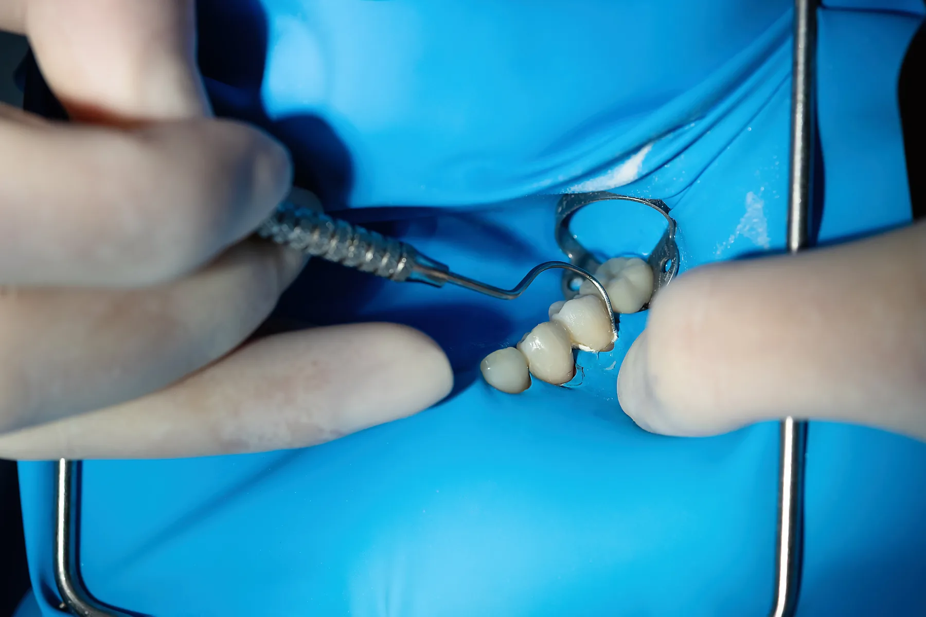 Dentist shaping a tooth-colored composite filling with rubber dam isolation