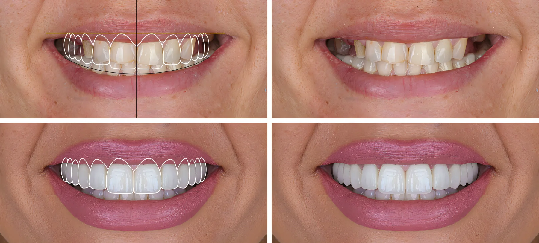 Digital cosmetic dentistry smile design and restoration planning