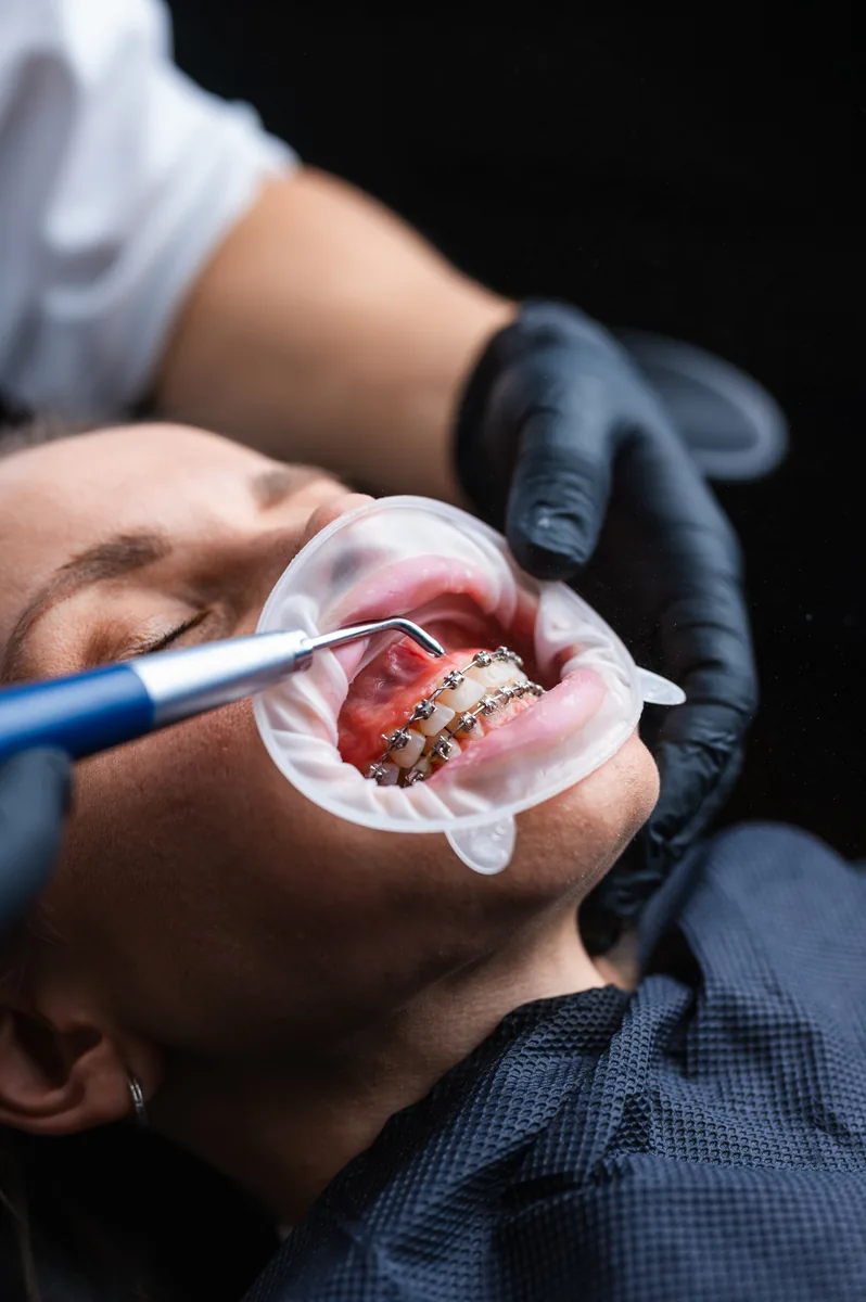 Dental hygienist completing professional scaling with suction