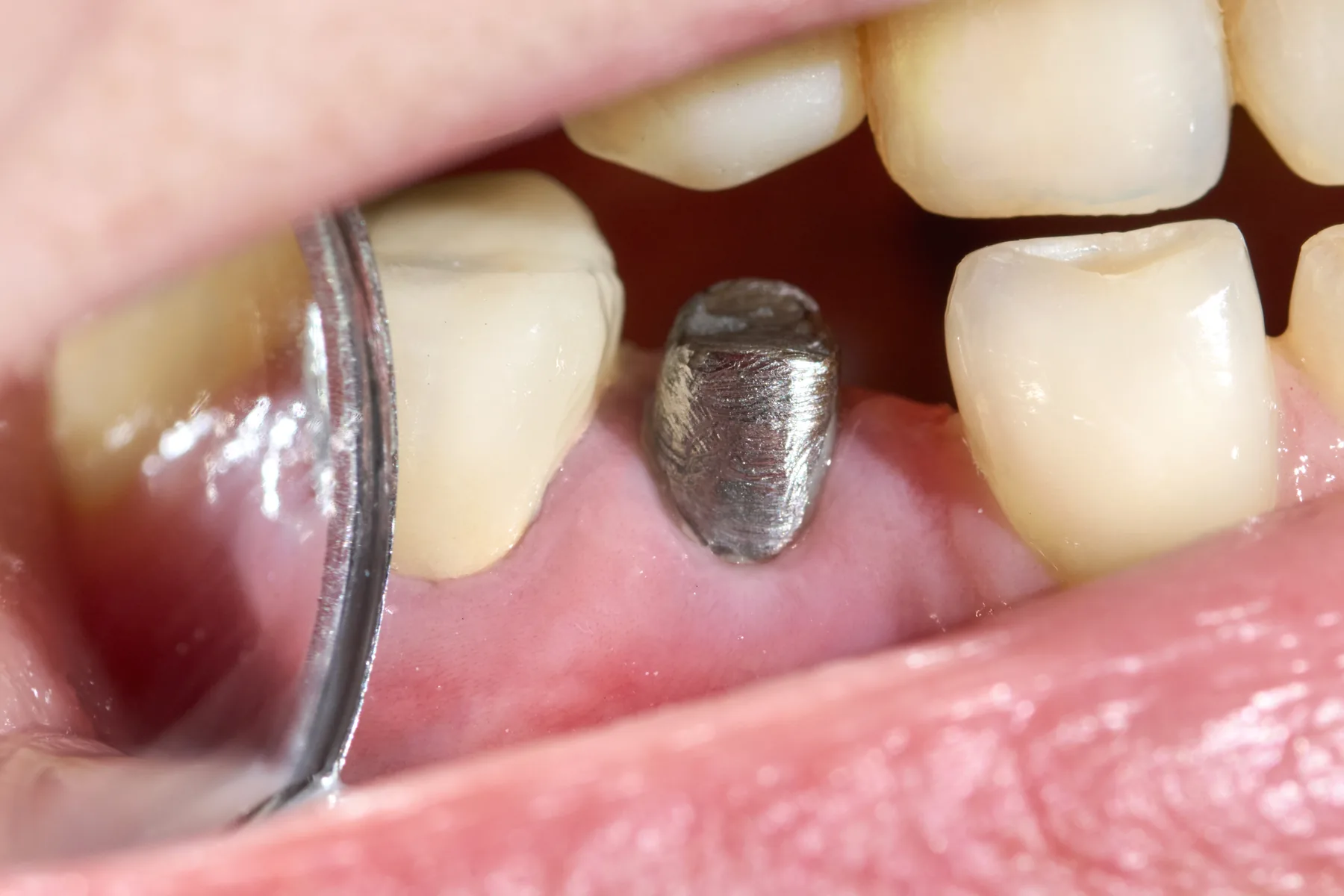 Dentist examining a healing dental implant abutment inside the mouth