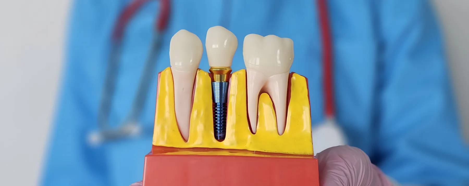 Dentist demonstrating dental implant and crown models