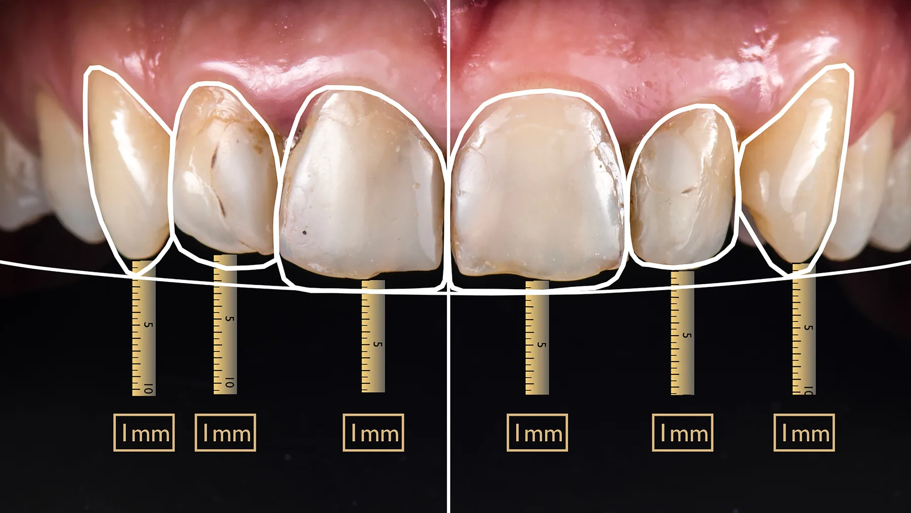 Digital smile design used to plan porcelain veneer treatment