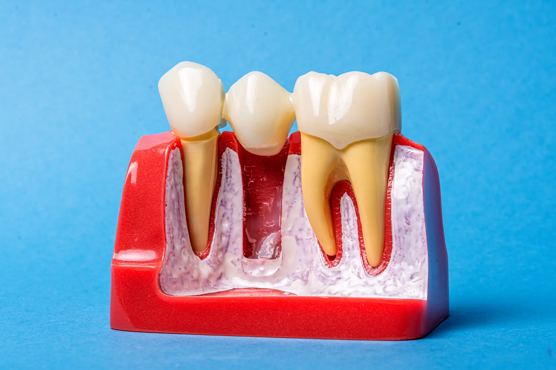 Dental bridge model demonstrating replacement of a missing tooth