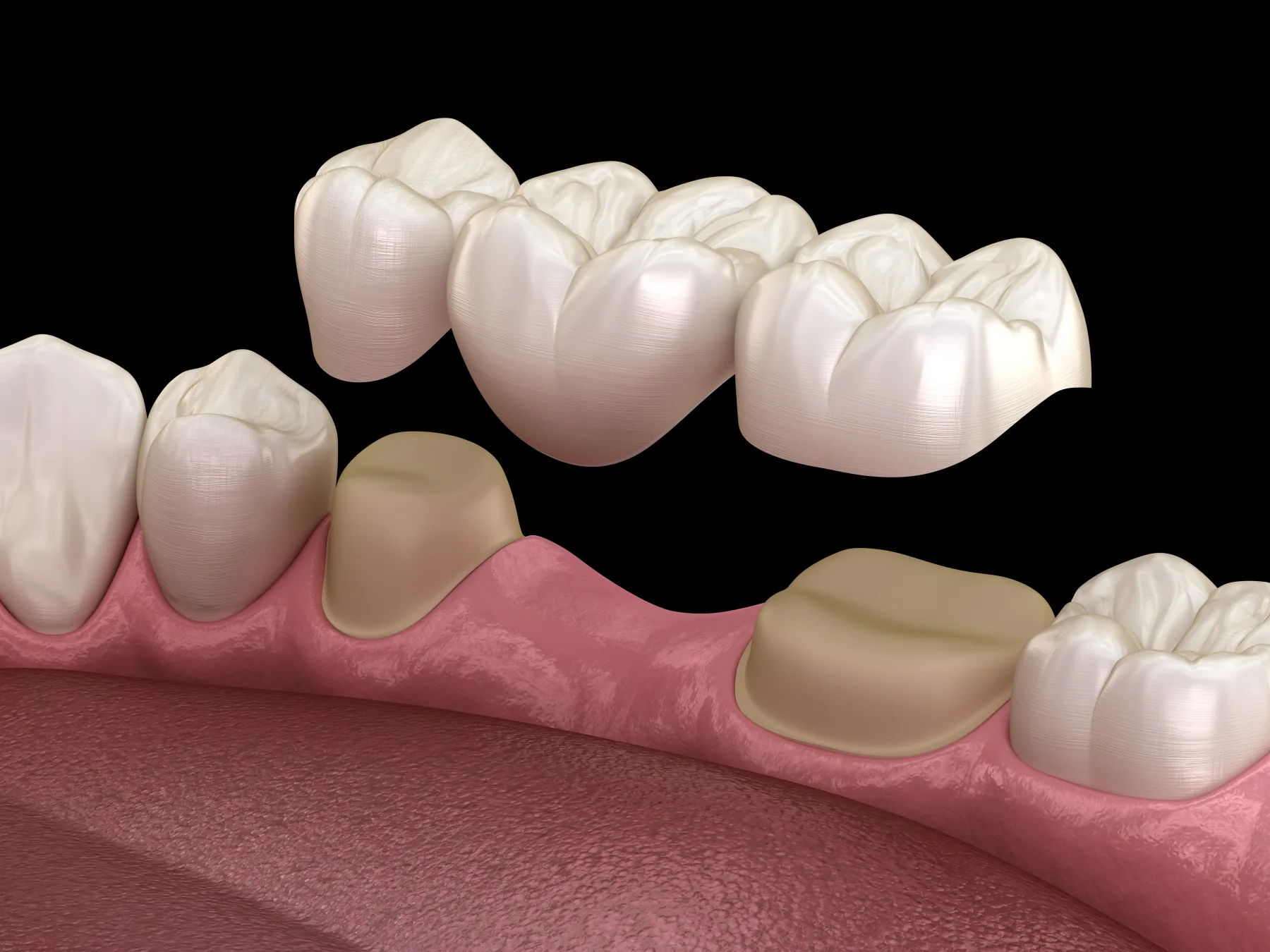 Three-unit fixed dental bridge replacing a missing tooth