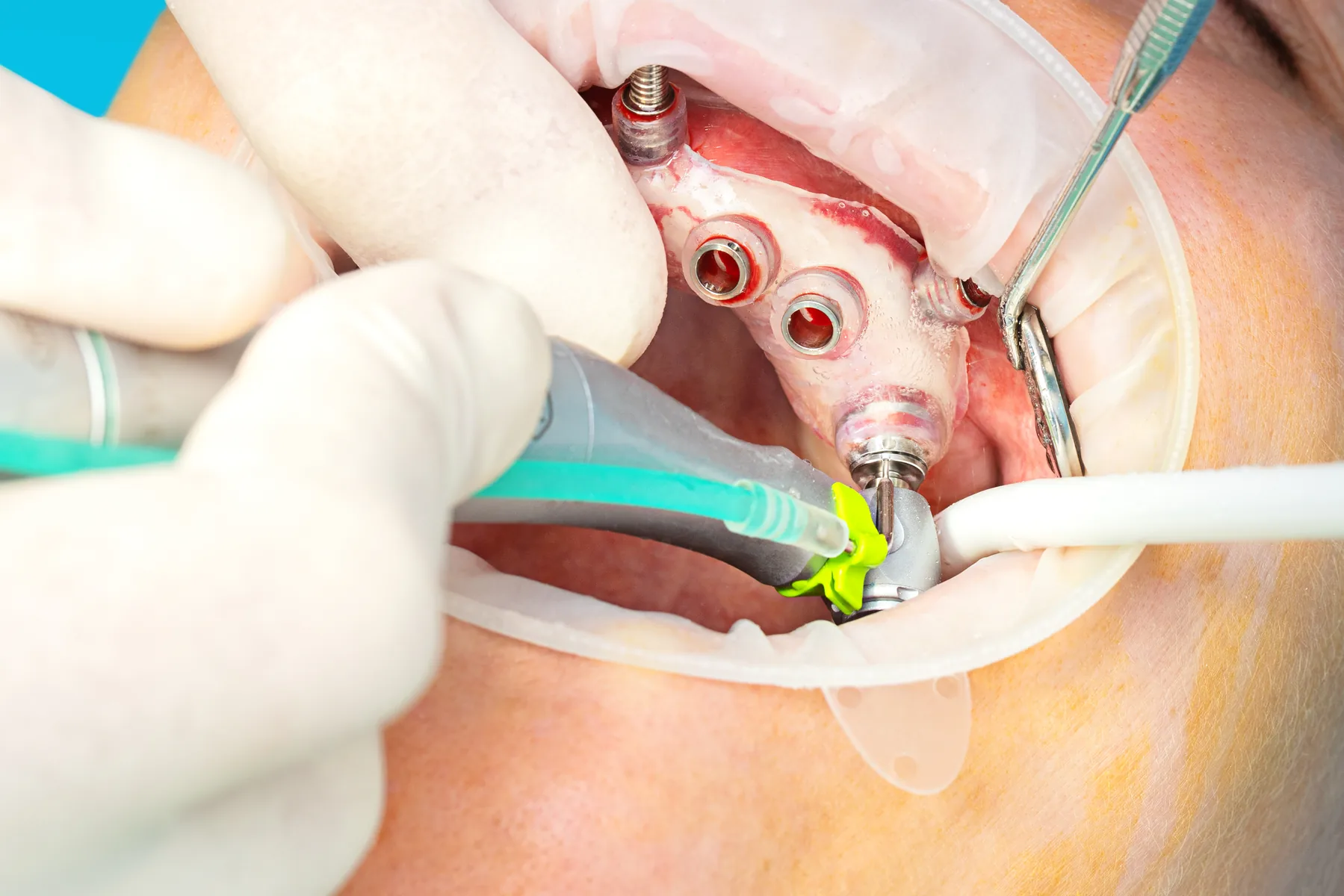Digital guided dental implant placement during a clinical procedure
