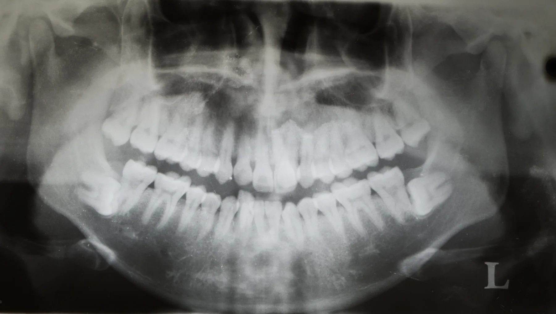 Panoramic dental x-ray showing impacted wisdom teeth