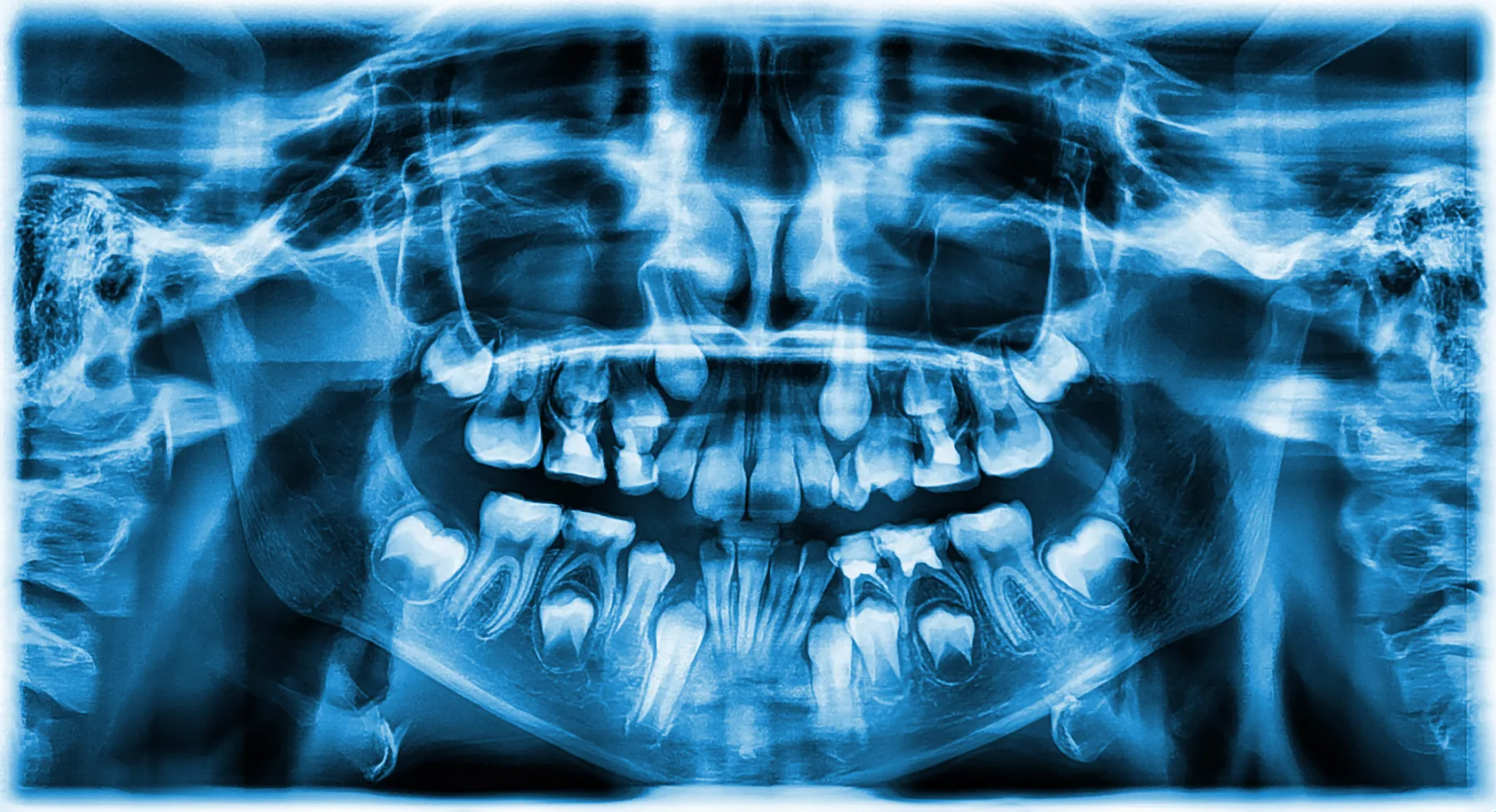 Dental X-ray showing common impacted wisdom tooth positions