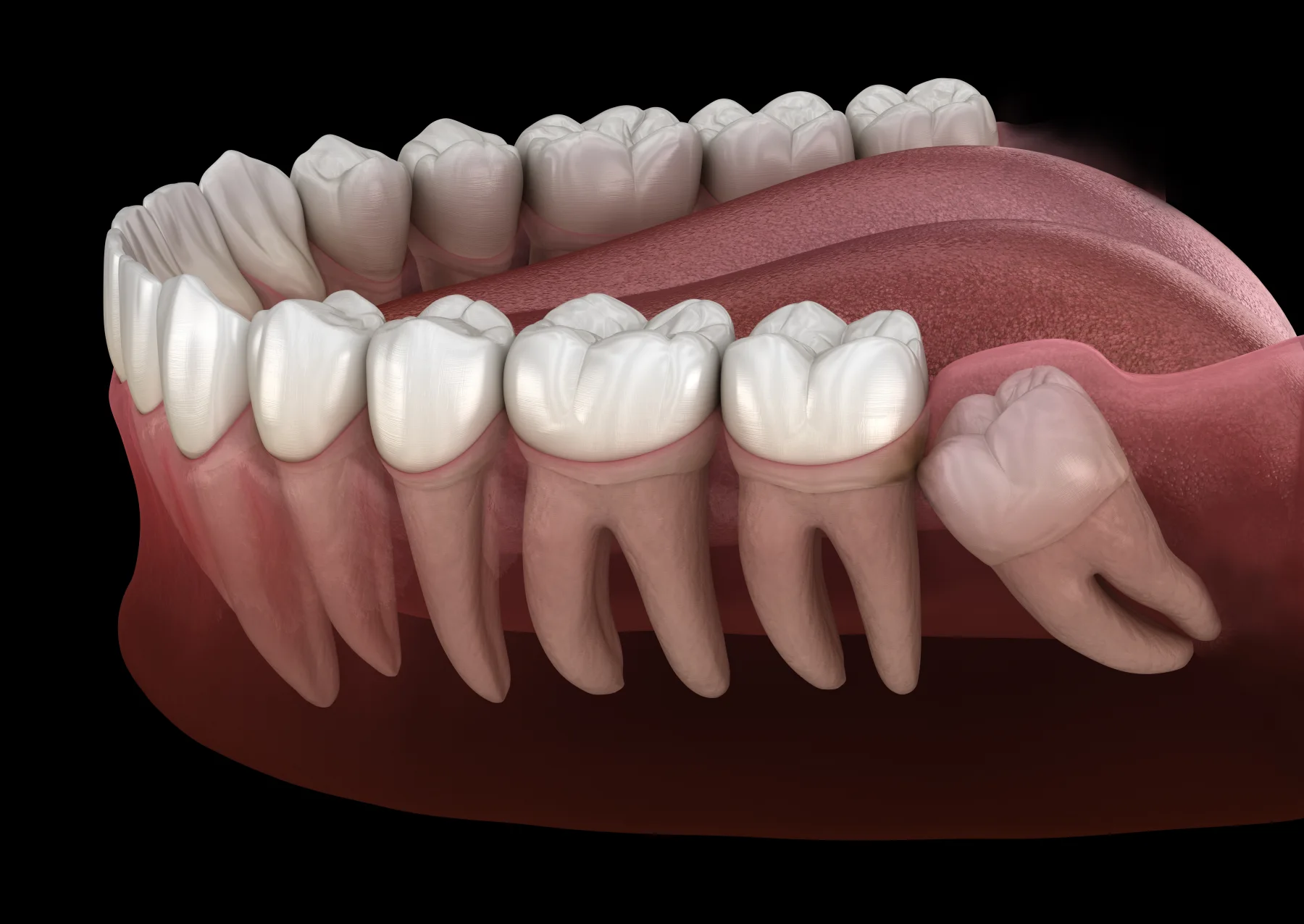 Mesially impacted wisdom tooth beside healthy molars