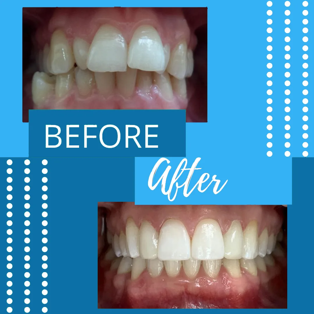 Adult orthodontic before-and-after result from the original Troup Family Dental website