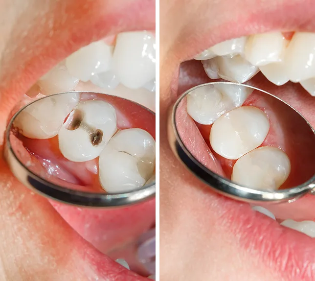 Before-and-after tooth-colored filling treatment shown on the original Troup Family Dental website