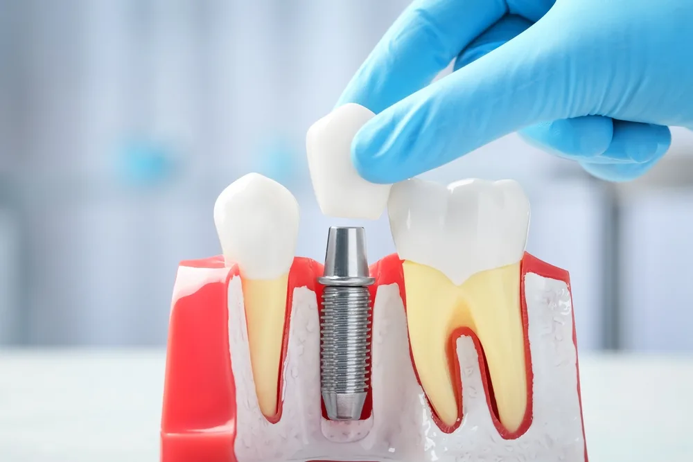 Dental implant crown image from the original Troup Family Dental implant page