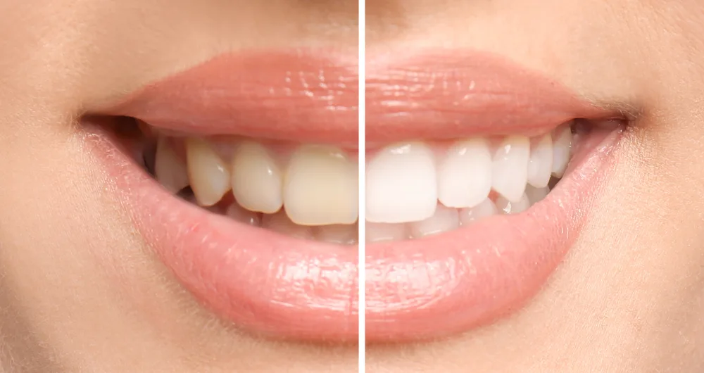 Professional whitening image from the original Troup Family Dental whitening page