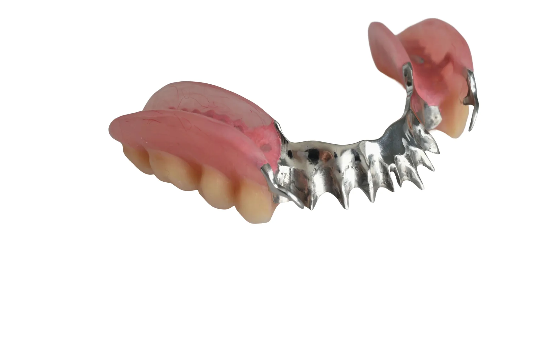 Lower partial denture with a durable metal framework and supportive clasps