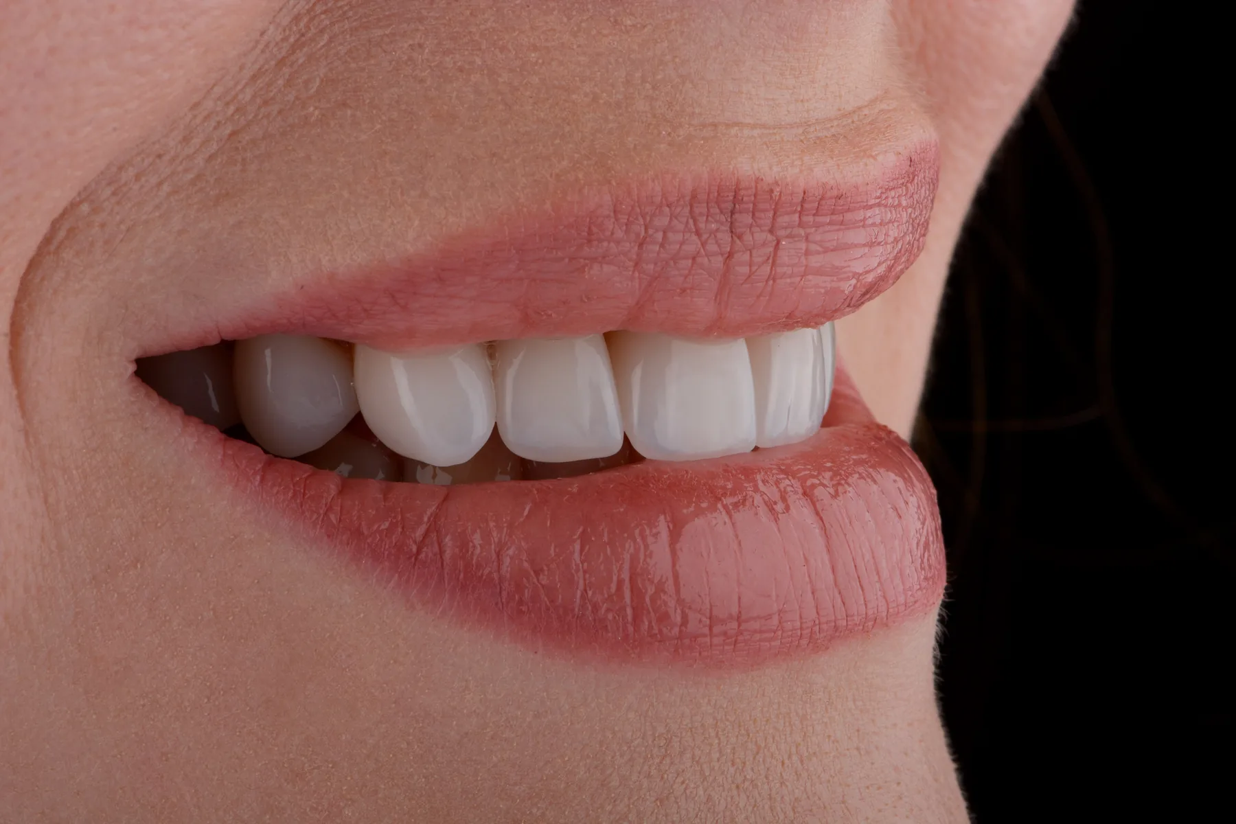 Side view of a natural-looking ceramic veneer smile makeover