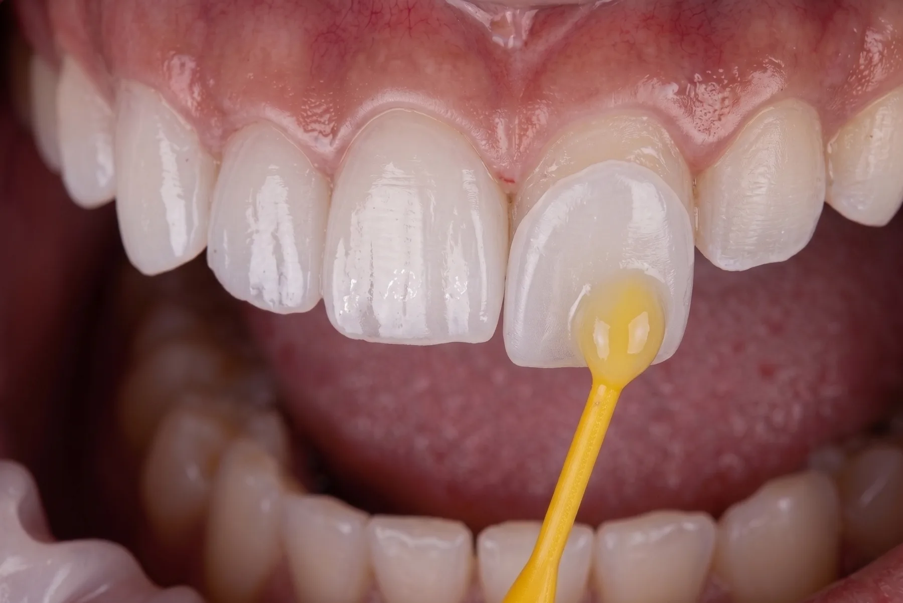 Porcelain dental veneer being positioned on a front tooth