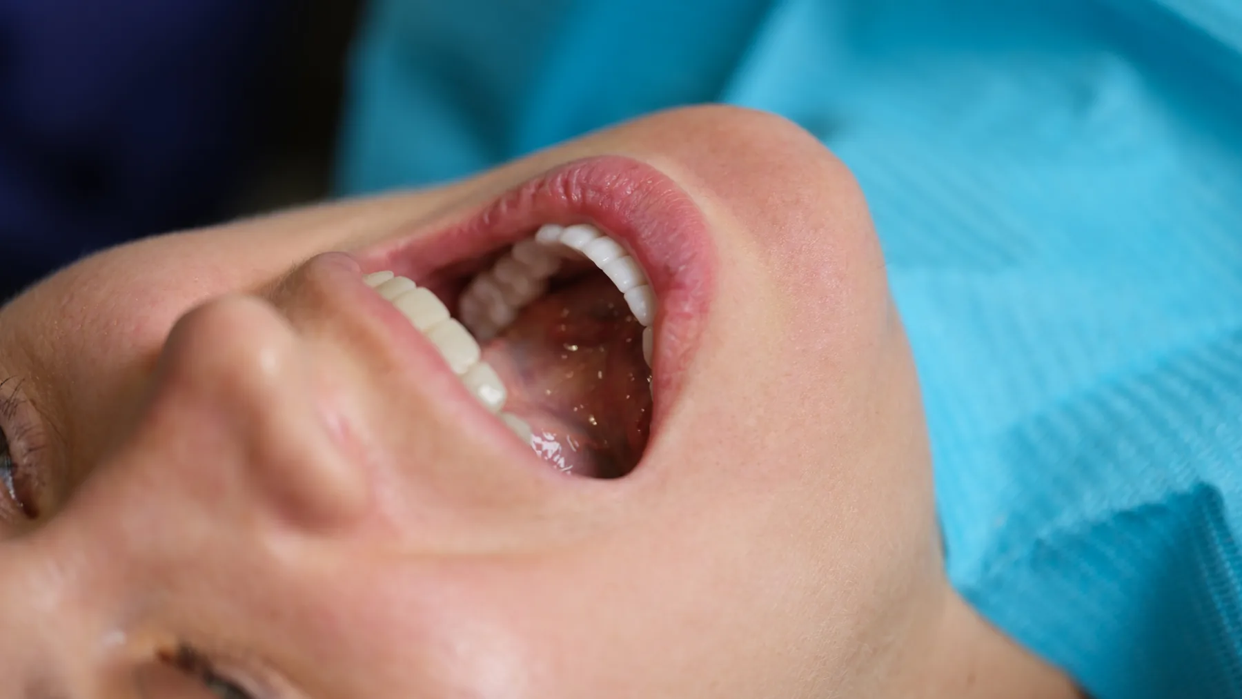 Clinical stages of porcelain veneer placement for discolored teeth
