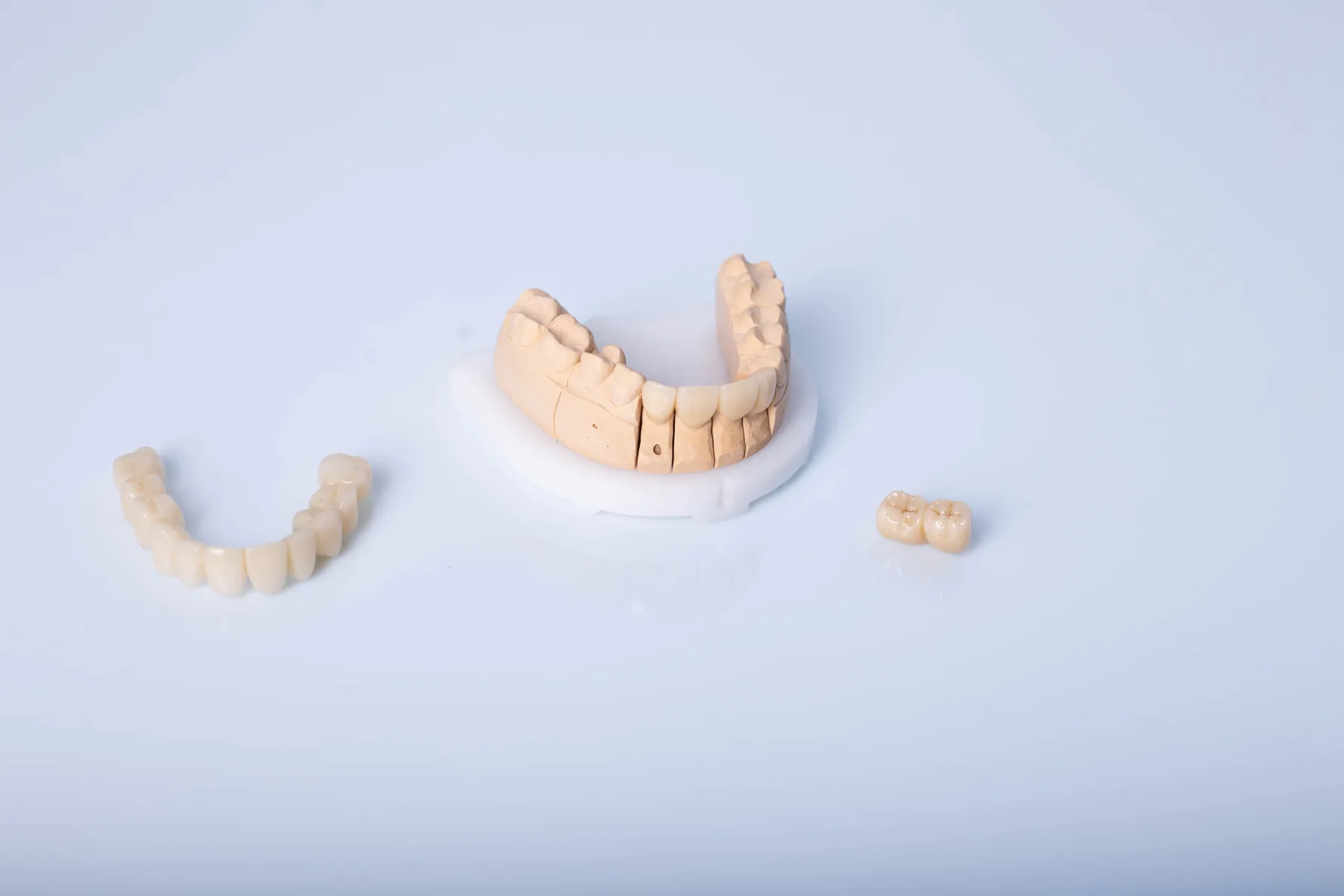 Glass-ceramic porcelain veneers prepared for smile design