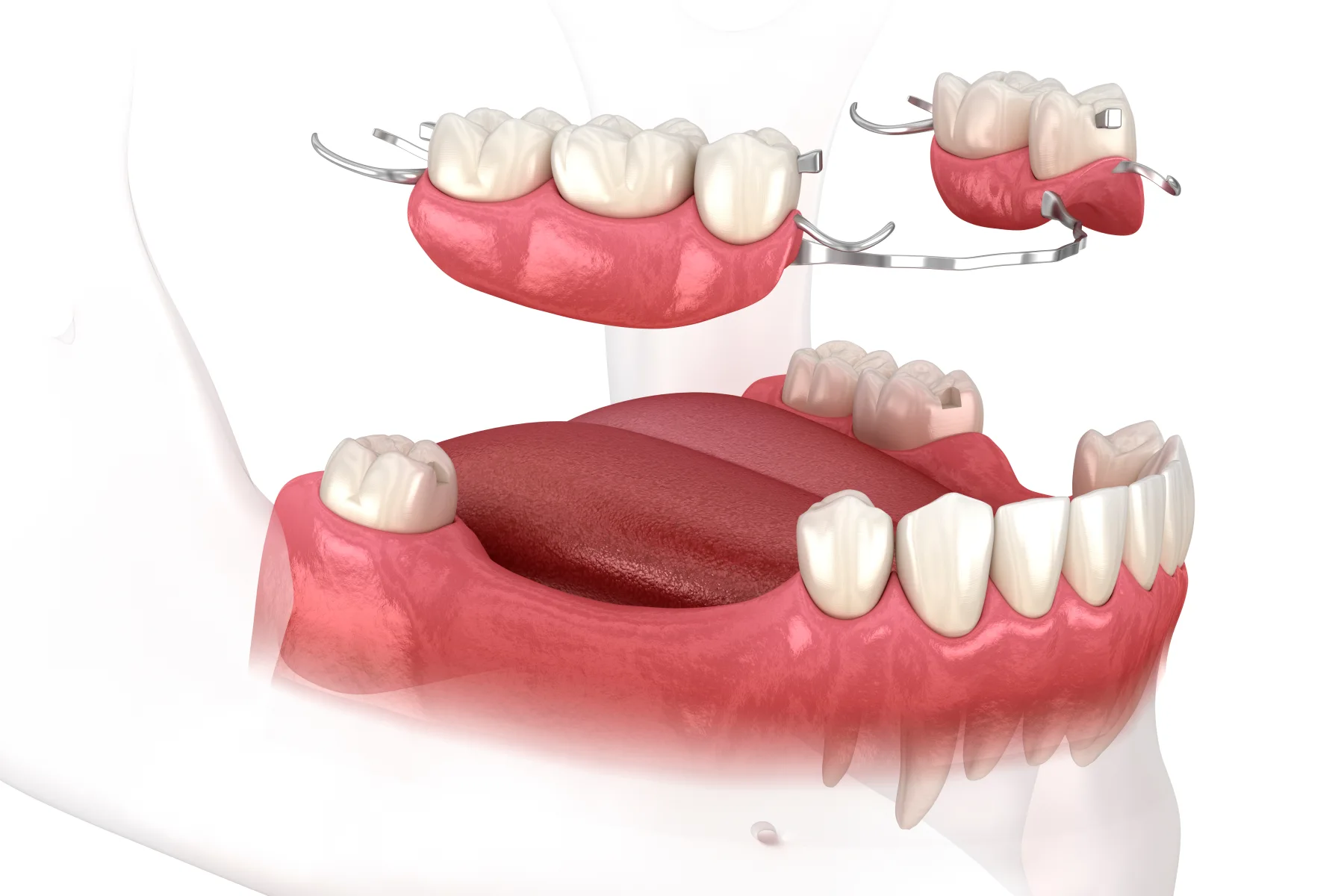 Removable mandibular partial denture prosthesis