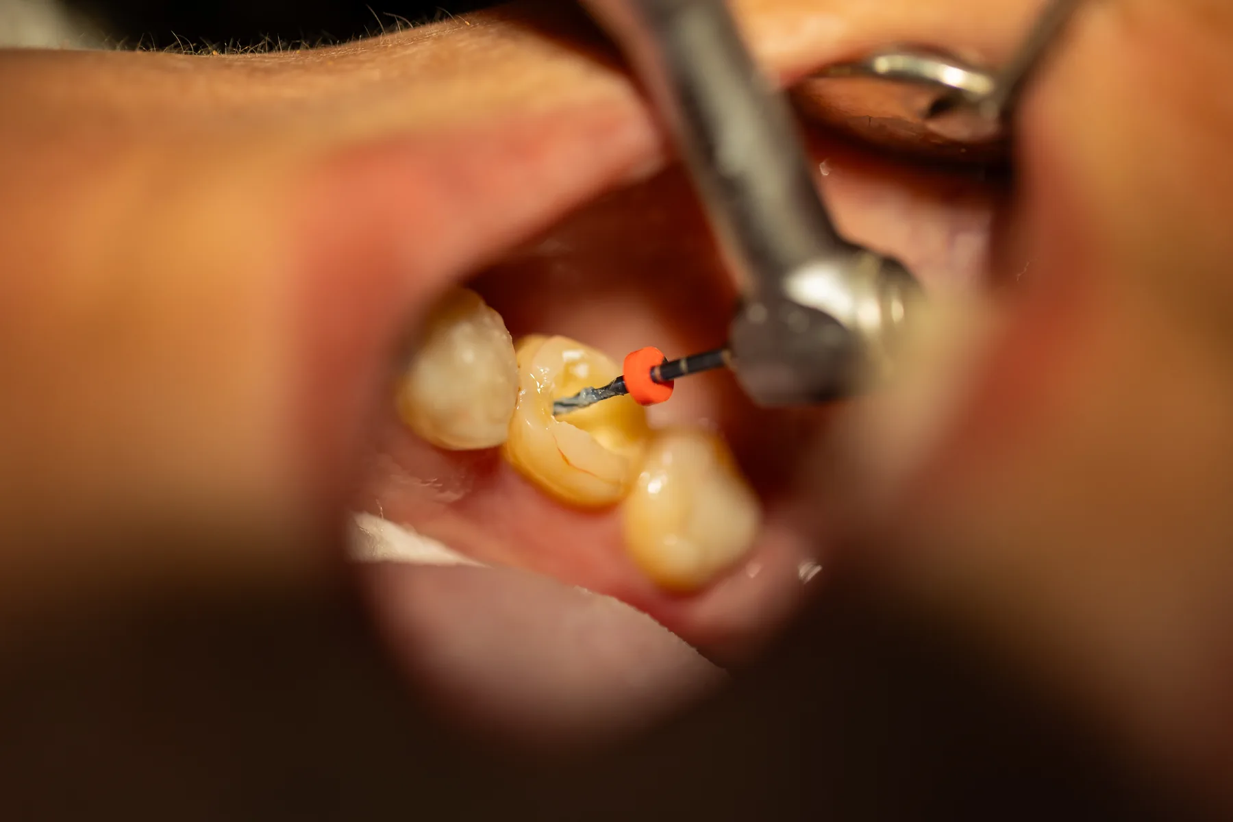 Dentist performing root canal treatment with a precision endodontic file