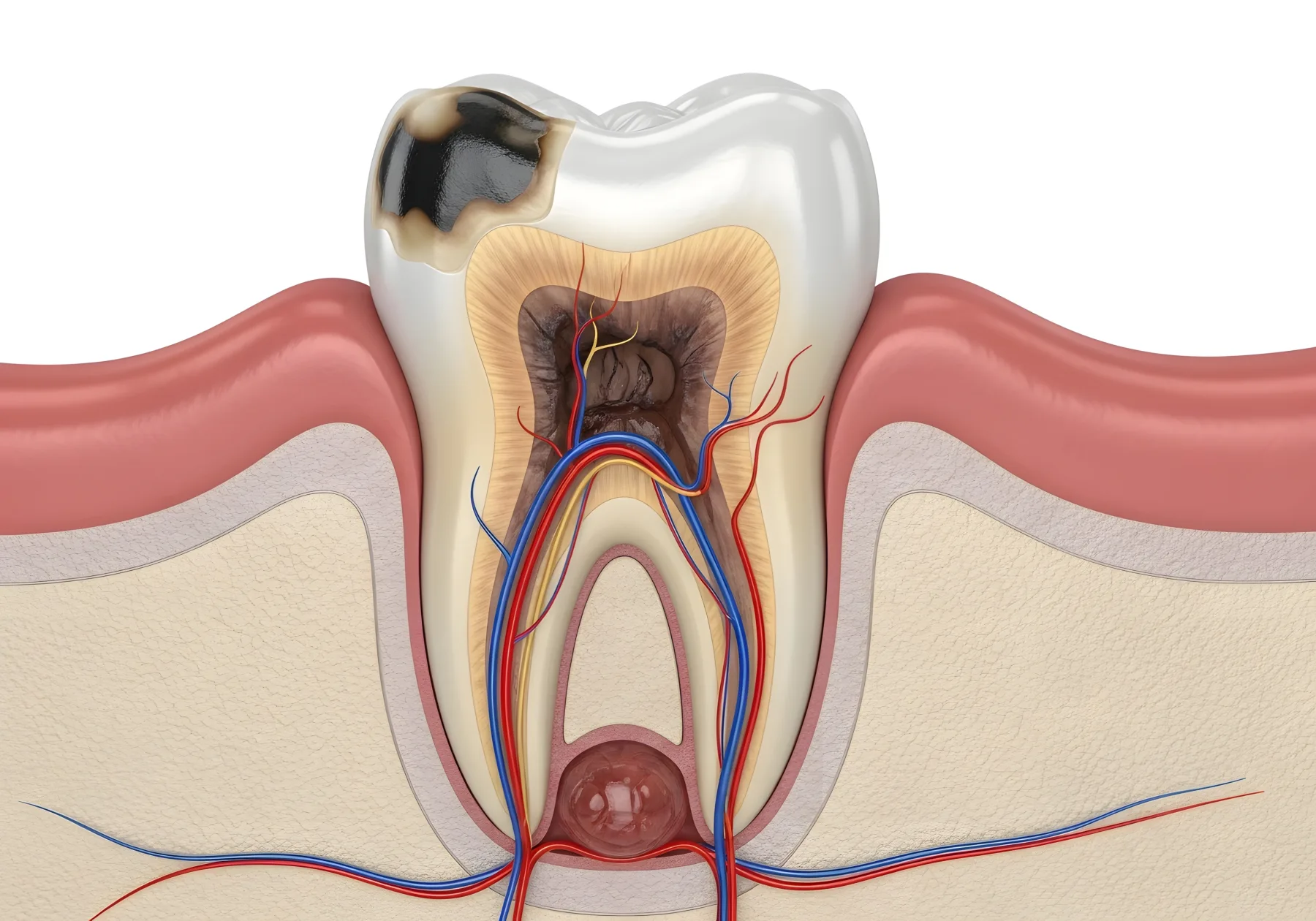 Tooth illustration showing decay and the root canal system
