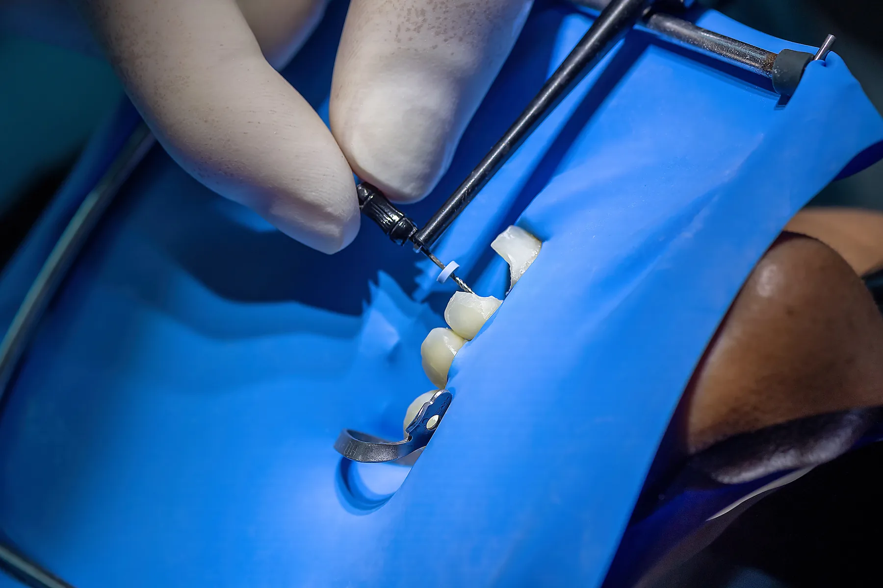 Endodontic file used during root canal treatment with rubber dam isolation