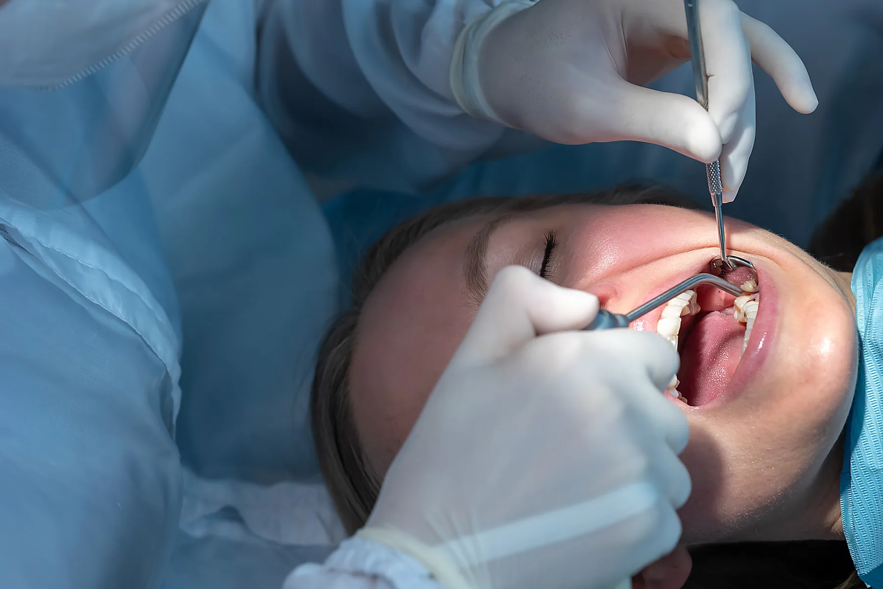 Prepared tooth being carefully dried before dental crown placement
