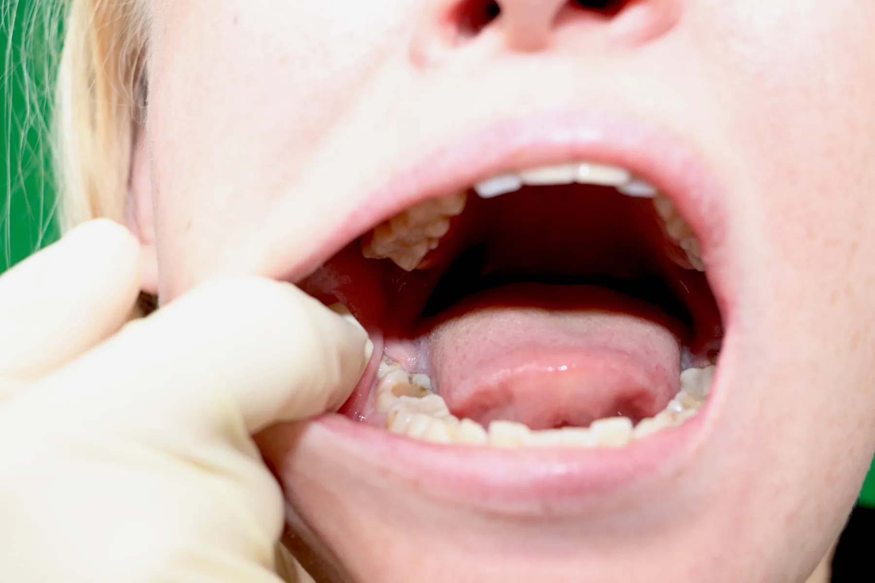 Clinical preparation for wisdom tooth removal
