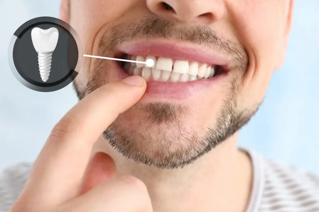 Dental Implants in Troup, TX: Are They the Right Choice for Replacing a Missing Tooth?